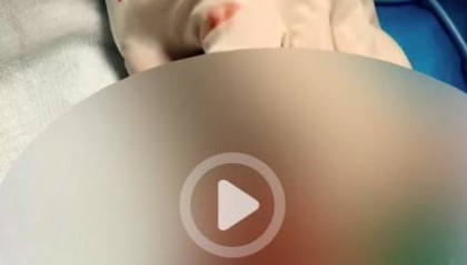 重庆13岁男孩割包皮后睾丸坏死被切除，手术器材是医生临时买的，医院：上级正在调查