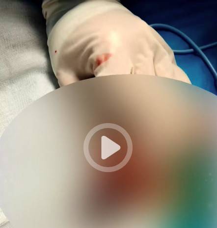 重庆13岁男孩割包皮后睾丸坏死被切除,手术器材是医生临时买的,医院:上级正在调查